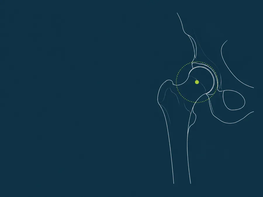 Line illustration of a hip joint